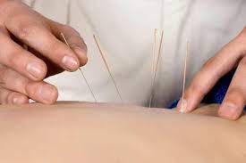 Dry Needling Physiotherapy in Surrey